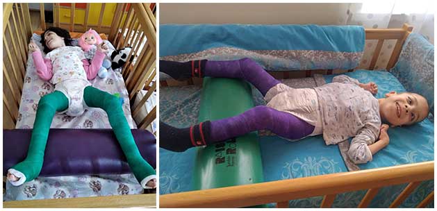 Levon and Lilit of Children's Home of Gyumri received the surgical procedures they needed that will give them both a change to walk!