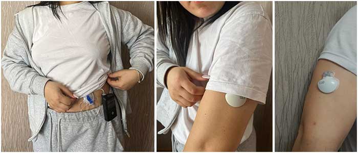 Insulin pump, transmitter and glucose sensor for continuous blood glucose monitoring device are installed.